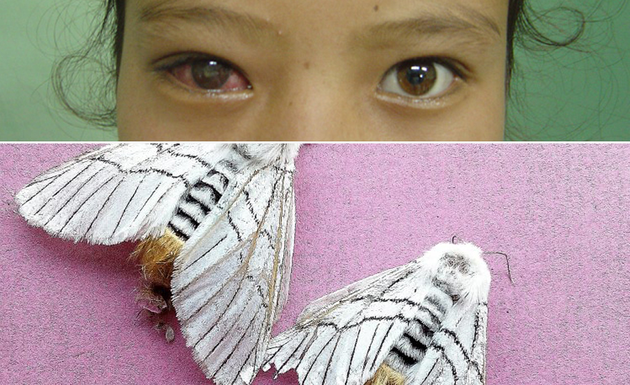 एकैसाथ डेङ्गी र सापुको जोखिम, कसरी जोगिने ?